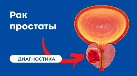 Симптомы увеличения предстательной железы