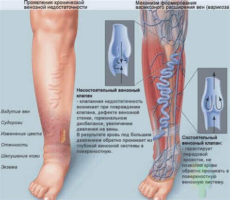 Симптомы уздг сосудов нижних конечностей вены
