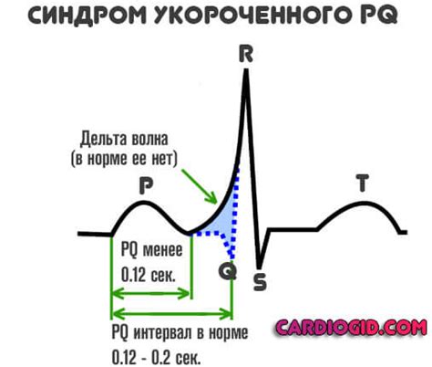 Симптомы укороченного интервала pq у ребенка