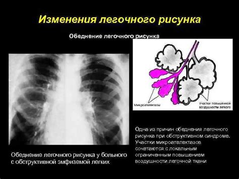 Симптомы умеренного усиления легочного рисунка