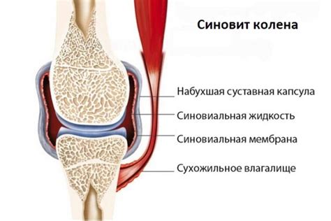 Симптомы умеренного экссудативного синовита