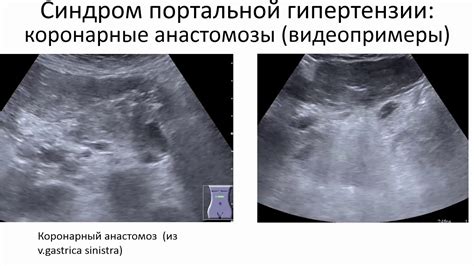 Симптомы умеренных диффузных изменений