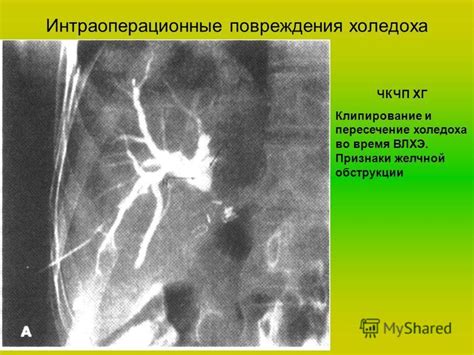 Симптомы уплотнения стенок желчных протоков