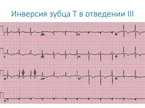 Симптомы уплощения зубца