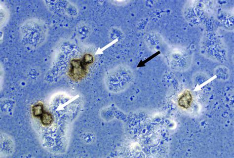 Симптомы уреаплазмоза при отсутствии роста ureaplasma spp