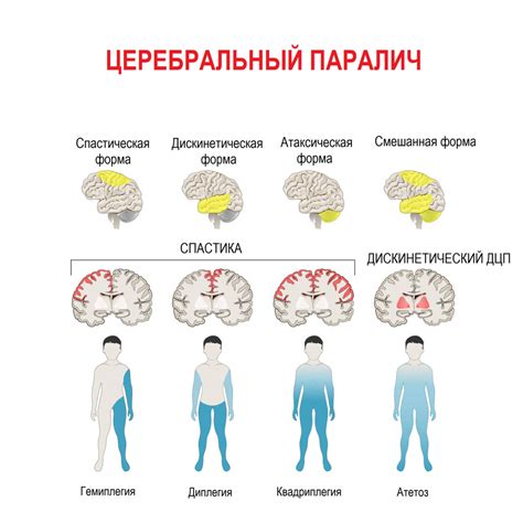 Симптомы церебрального инсульта: объяснение немоты