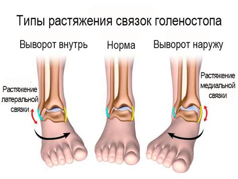 Симптомы частичного повреждения связок