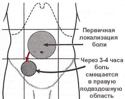 Симптом Кохера: ранняя диагностика и лечение