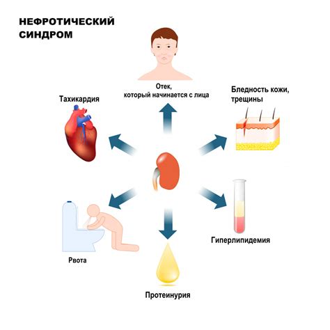 Синдром "превышение критического значения"