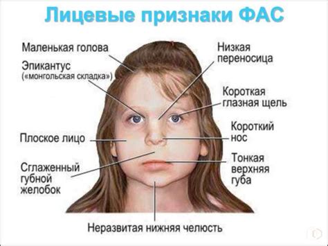 Синдром ФАС у детей: диагностика и лечение