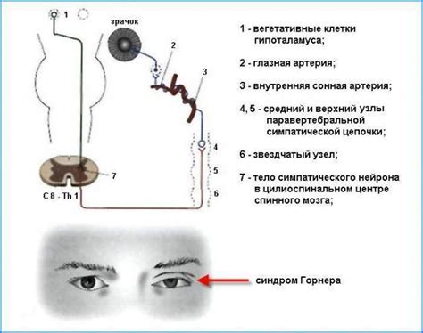 Синдром зрачка положительный