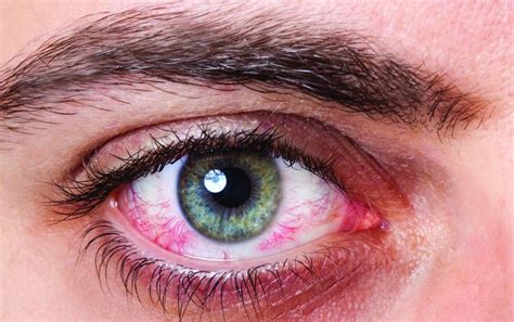 Синдром сухого глаза и склероз