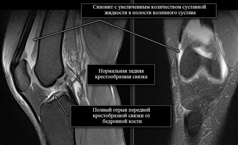 Синовит и надрыв в колене