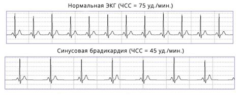 Синусовая брадикардия при ЭКГ: обзор, диагностика и лечение