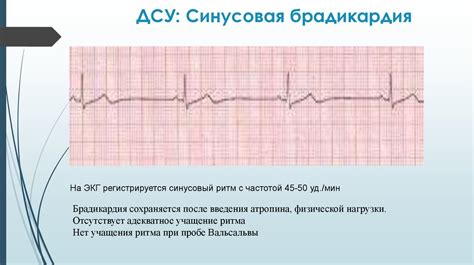 Синусовая брадикардия у детей