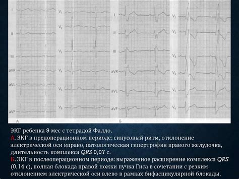 Синусовый ритм: передвижение электрической оси вправо у детей