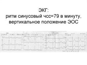 Синусовый ритм: положение ЭОС и значение