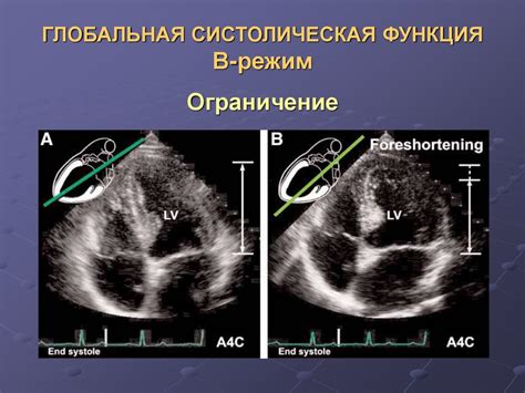 Систолическая функция миокарда и ее значение