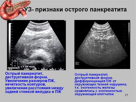 Сложности диагностики реактивного панкреатита