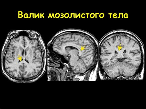 Советы по профилактике мозолистого тела