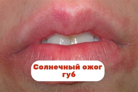 Солнечные ожоги губ: симптомы и способы лечения