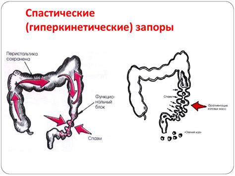 Спастический запор: основная информация