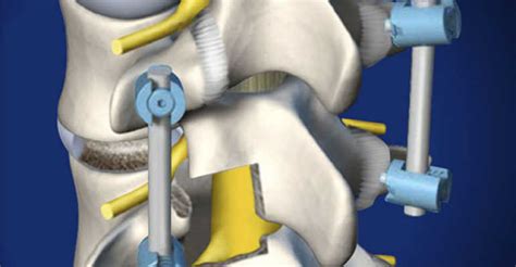 Спондилодез как метод лечения заболеваний позвоночника