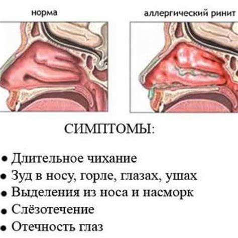 Способы избавления от запущенной сопли