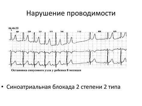 Способы исправления нарушения проводимости