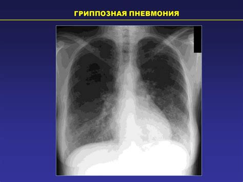 Способы лечения инфильтративных изменений правого легкого