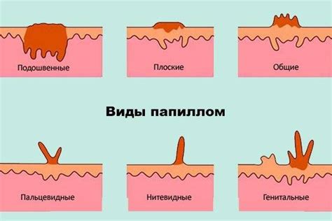 Способы удаления папилломы под мышкой