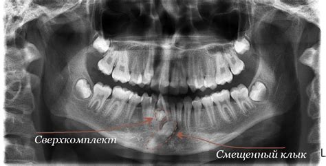 Способы удаления сверхкомплектного зуба