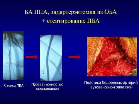 Стеноз ПБА: определение и значение