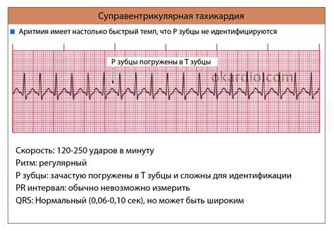 Суправентрикулярная тахикардия