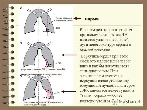 Существуют ли лечебные методы для расширения тени сердца?