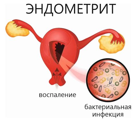 Существующие причины хронического умеренно активного эндометрита