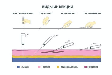 Техника выполнения инъекции внутримышечно