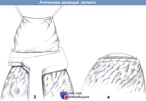 Техника проведения резекции легкого