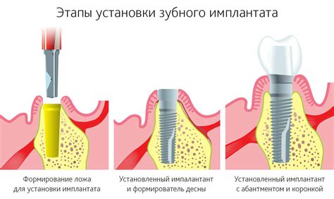 Технология изготовления акриловых зубов