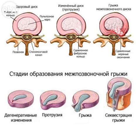 Типы грыж и их локализация