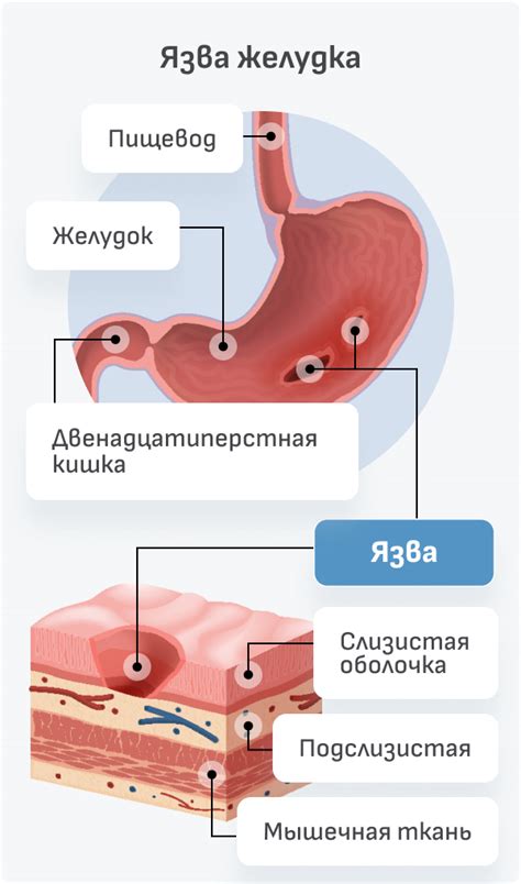 Типы клеток в язве желудка