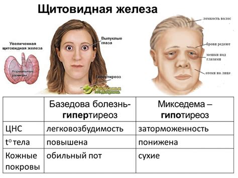 Тиреотоксикоз и нарушения щитовидной железы