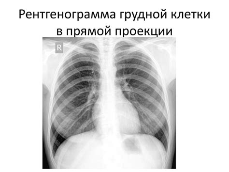 Тотальное гомогенное затемнение