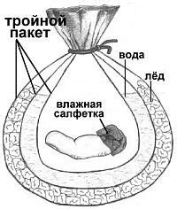 Травматическая ампутация и ее последствия