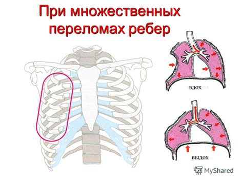 Травма или контузия грудной клетки