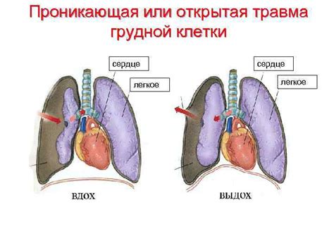 Травма или повреждение грудной клетки могут привести к сдуванию легкого