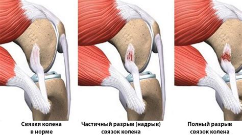 Травмы и повреждения при простреле в колено