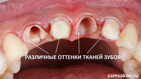 Трактовка падения зубов с присутствием крови: благоприятное или несчастливое предзнаменование?