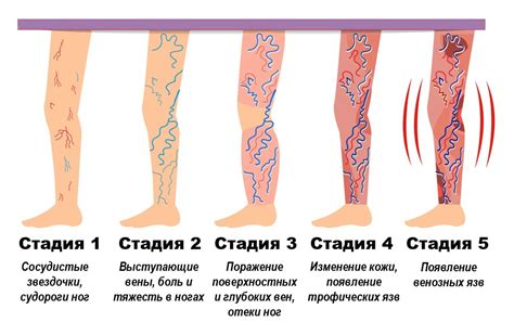 Тромбофлебит