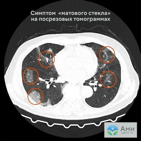 Туберкулезные поражения легких